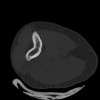 SPORK, NICO - 22.03.1976 - 02.08.2022 - CT obere Extremität - 17:51:17